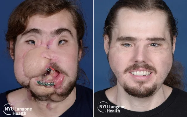 The face transplant gave the 26-year-old a 'second chance at life' and shows a promising future for the sick