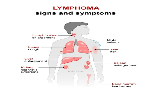 The profile of the disease-lymphoma